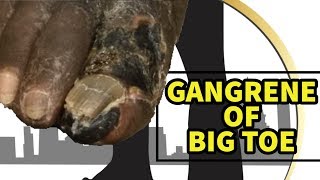 GANGRENE BIG TOE Prevention of Amputation [upl. by Yvi]