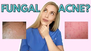 Do YOU have Fungal Acne  Dermatologist Talks Symptoms and Treatments [upl. by Plafker]