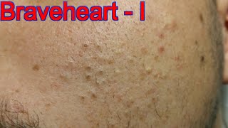 Extraction for Teenage Acne  Part 1 of 3 [upl. by Jemy]