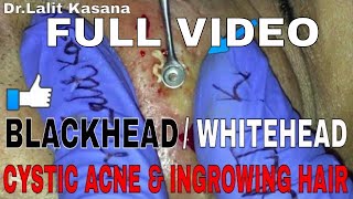 COMEDONES and CYSTIC ACNE POPPING FULL VIDEO 2 [upl. by Lienaj]