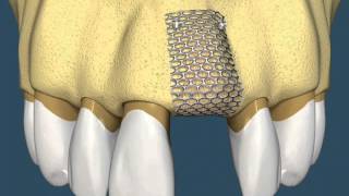 Implantes Dentários  Com Enxerto Ósseo [upl. by Oibirot122]