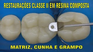 Restauração Classe II em Resina Composta  PARTE 1 [upl. by Hen]