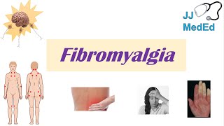 Fibromyalgia  Symptoms Associated Conditions Diagnosis Treatment [upl. by Hehre]