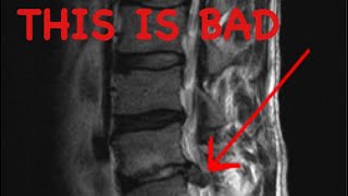 How to Read a Spine MRI [upl. by Nimesh557]