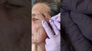 Acne extraction of blackheads and whiteheads popping pimples in Los Angeles [upl. by Obelia]