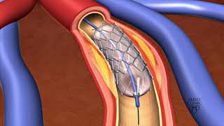 Stent Application sinusVenous [upl. by Cornish631]