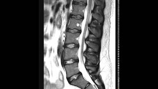 MRI Sagittal Section View Showing Normal CervicalThoracic Spine Sequence Planning beginners [upl. by Jamieson]