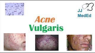 Acne Vulgaris  Causes Pathogenesis Influencing Factors Diagnosis Treatment and Complications [upl. by Gweneth]