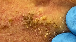 Extremely Clogged Pores Extracted  Contour Dermatology [upl. by Alemahs]