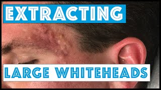 Acne Vulgaris and Extracting large Whiteheads  Part 1 [upl. by Tegdig]