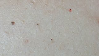 Acne Treatment on the Back Uninfected Lesions [upl. by Ashraf96]