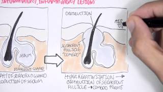 Acne Pathophsyiology [upl. by Humfried911]