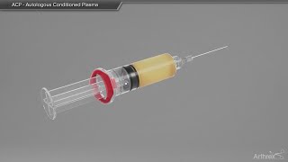 ACP  Autologous Conditioned Plasma [upl. by Lleirbag208]