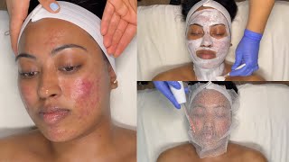 CYSTIC ACNE TREATMENT  WALKIN FACIAL FOR GRADE 3 AND 4 ACNE WITH PRO TIPS  LICENSED ESTHETICIAN [upl. by Flor]