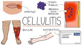 What is Cellulitis  Symptoms and Treatment Options [upl. by Ettenna]