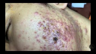 ACNE TREATMENT FOR Mạnh past 2 45  Loan Nguyen [upl. by Bonita]