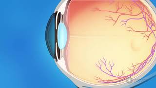 Case Study with SPECTRALIS OCT Glaucoma [upl. by Hsilgne]