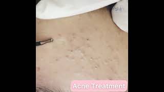 Comedone Extraction Acne Treatment [upl. by Hofstetter968]