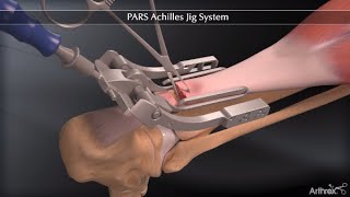 PARS Achilles Jig System [upl. by Nero]