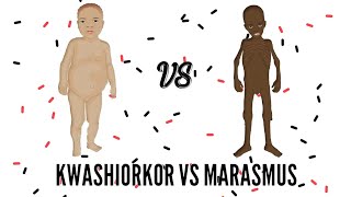 SAM  Severe Acute Malnutrition  Kwashiorkor VS Marasmus [upl. by Theodoric4]