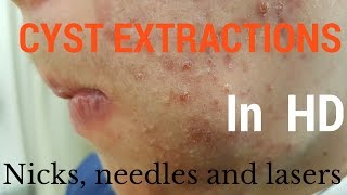 Cysts extractions blackheads  Removal methods in HD [upl. by Budding741]