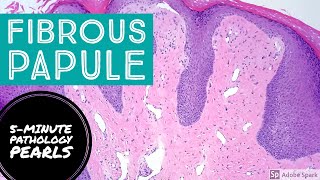 Fibrous Papule Angiofibroma 5Minute Pathology Pearls [upl. by Coffeng866]