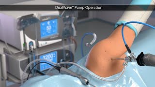 DualWave™ Pump Operation [upl. by Hannahoj]