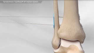 Syndesmosis TightRope® XP Implant System [upl. by Errol]