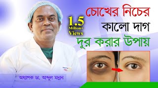 How To Remove Dark Circles  চোখের নিচের কালো দাগ দূর করার উপায়  Choker Nicher Kalo Dag Dur Kora [upl. by Ayidah506]