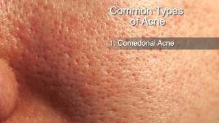 How to Treat Different Types of Acne [upl. by Enellek]