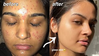 how i cleared my acne FOR GOOD something finally worked [upl. by Bonilla293]