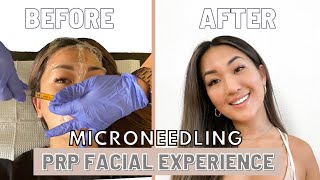 Full PRP Facial  Microneedling Experience  BeforeAfter Recovery [upl. by Gore]