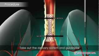 SampG BiotechEGIS Airway Stent [upl. by Eniladam518]