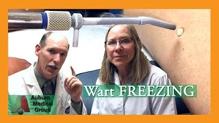 Wart Freezing  Auburn Medical Group [upl. by Aridatha]