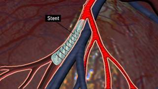 You and Your Stent [upl. by Ches]