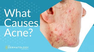 What Causes Acne  Explained by Dermatologist [upl. by Aihsaei]