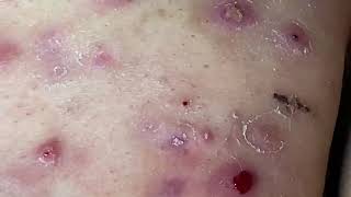 Cystic Acne Cysts Acne Dermatology Comedones and Whiteheads [upl. by Eelarat]