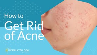 Acne Treatment  Explained by Dermatologist [upl. by Torrlow]