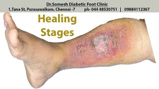 From Cellulitis to Necrotizing Fasciitis  EM amp Acute Care Course [upl. by Dumas99]