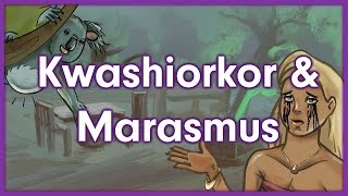 Kwashiorkor vs Marasmus  Nutrition Mnemonic [upl. by Valleau477]