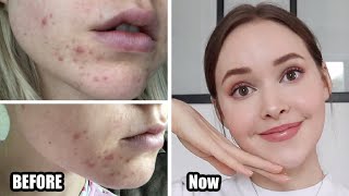 How To Really Get Rid Of Acne amp textureacne scarsskin damage Adult Hormonal Acne [upl. by Ednalrim407]