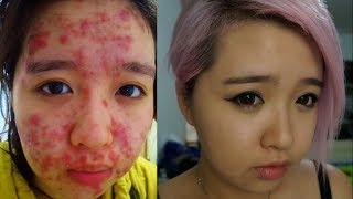 From Severe Acne to Clear Skin [upl. by Ladonna]