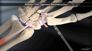 Arthrex CMC Ligament Reconstruction [upl. by Hsak]