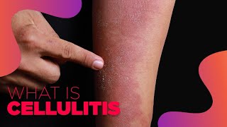 Cellulitis Bacterial infection  RIFE Frequencies Treatment  Energy amp Quantum Medicine [upl. by Zitah]