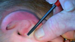 Painful Ear Pimple Popped and Slowly Pressured [upl. by Eniak225]